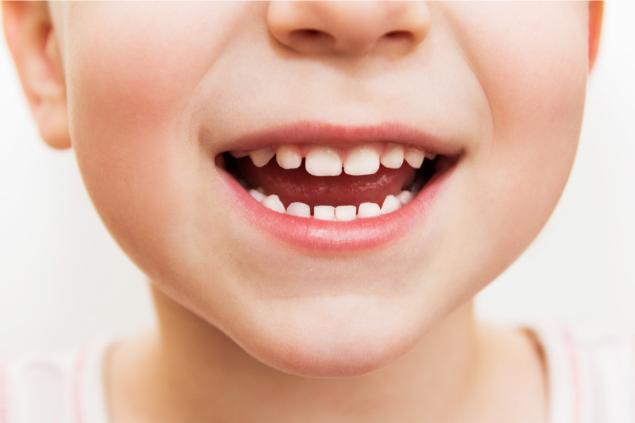 Closeup of a child's baby teeth that have cavities in Columbus, OH